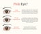 Eye disease. Ophthalmology health illustration.