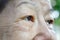 Eye edema in elderly woman