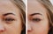 Eye girl bag under the eyes removal before and after treatment cosmetic procedures