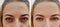 Eye girl bag under the eyes before and after treatment cosmetic procedures