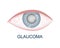 Eye with glaucoma closeup view. Hazy, redness, watery eyeball. Anatomically accurate human organ of vision. Aging visual