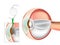 Eye Lens Replacement Surgery. Lens Implant. Cataract Surgery. Intraocular Lenses IOL.