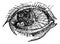 Eye with Pustular Conjunctival Keratitis, vintage engraving