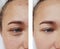 Eye wrinkles young woman before and after cosmetology procedures