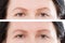 Before after eyebrow threading and eyebrows shaping cosmetic procedure. Closeup middle age woman face. Before-after skin and