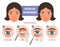 Eyelid surgery procedure before after illuatration with main steps. Excess skin and fat removal.