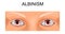 The eyes of a person suffering from albinism