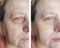 Face couperose of an elderly aging face treatment wrinkles before and after procedures