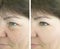 Face  couperose of an elderly aging    patient  treatment wrinkles before and after procedures