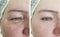 Face couperose of an elderly woman face treatment wrinkles before and after procedures