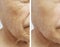 Face elderly man patient forehead wrinkles medicine therapy face before and after procedures