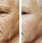 Face of an elderly man wrinkles face before and after procedures
