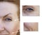 Face of an elderly surgery woman wrinkles young dermatology treatment face collagen ,before and after procedures