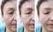 Face, elderly woman, wrinkles, filler cosmetology patient contrast correction before and after procedures, arrow