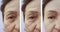 Face, elderly woman, wrinkles, plastic filler difference patient contrast correction before and after procedures, arrow