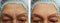 face of an elderly woman wrinkles therapy clinical before and after procedures
