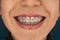 Face of the girl smiling with braces on her teeth against