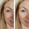 Face girl wrinkles before and after lift results lifting facial procedures