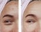 Face girl wrinkles before and after removal dermatology regeneration procedures