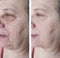 Face an older woman before and after difference treatments