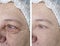 Face  an older woman before and after treatments