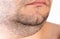 The face of an overweight man. Fat double chin. Aesthetic defect. double chin correction, close-up