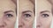 Face woman skin wrinkles before and after aging cosmetology mature procedures