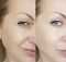 Face woman wrinkles eyes contrast regeneration before and after