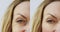 Face wrinkle woman before and after