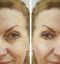 Face wrinkle woman before and after correction