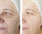 Face wrinkles elderly woman  difference before and after rejuvenation treatment