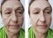Face wrinkles elderly woman before and after effect procedures