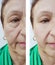 Face wrinkles elderly woman therapy plastic lifting before and after effect procedures