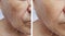 Facial elderly man patient forehead wrinkles injection antiaging effect medicine therapy face before and after procedures