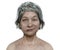 Facial palsy in a woman, 3D illustration highlighting the asymmetry and drooping of the facial muscles on one side of the face