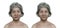 Facial palsy in a woman and the same healthy person, 3D illustration showing the asymmetry and drooping of the facial muscles on