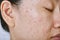 Facial skin problem, Acne disease in adult, Close up woman face with whitehead pimples, Oily greasy face