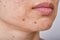 Facial skin problem, Acne disease in adult, Close up woman face with whitehead pimples, Oily greasy face