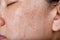 Facial skin problem, Acne disease in adult, Close up woman face with whitehead pimples, Oily greasy face