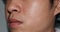 Fair skin with wide pores in oily face of Asian, Myanmar or Korean man