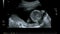 Fast motion of an ultrasound examination of a pregnant woman with an embryo and luminous lines, echography of fetus