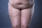 Fat female belly after pregnancy, stretch marks and varicose veins closeup