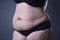 Fat female belly, stretch marks closeup