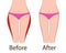 Fat and slim girls` hips. Before and after.