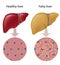 Fatty liver disease