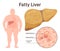 Fatty liver disease, NAFLD. Extra fat in the liver. Overweight person