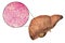 Fatty liver, liver steatosis