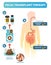 Fecal transplant therapy, procedure steps diagram, vector illustration. Renewing human digestive microflora.