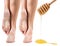 Feet with dry skin before and after honey treatment.