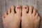 Feet on the floor. Damaged nails. Bruise under thumb nail. Barefoot close up. Nail illness. Health treatment. Foot care concept.